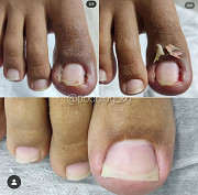 Подолог Бишкек Вросший ноготь @podolog_kg Бишкек