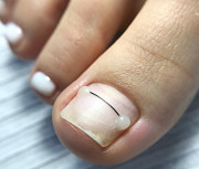 Подолог Бишкек Вросший ноготь @podolog_kg Бишкек